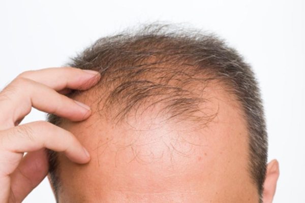 Cómo saber si sufro de alopecia - imagen de la parte superior de la cabeza de un hombre con graves síntomas de alopecia