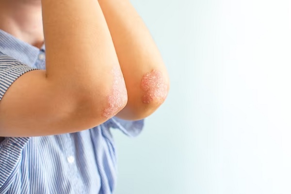 imagen de los codos con psoriasis de un niño con camisa a rayas