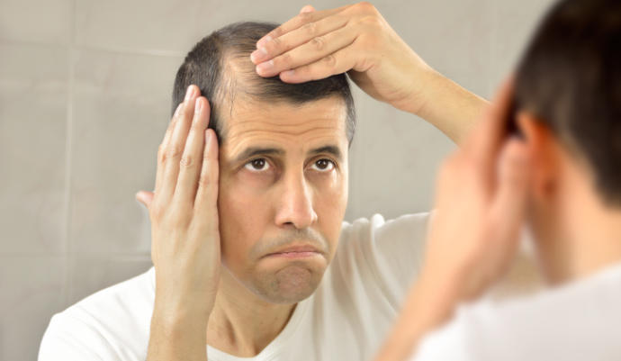 evitar la caída del cabello - hombre triste mirándose al espejo comprobando el avance de la alopecia en las entradas de su cabello