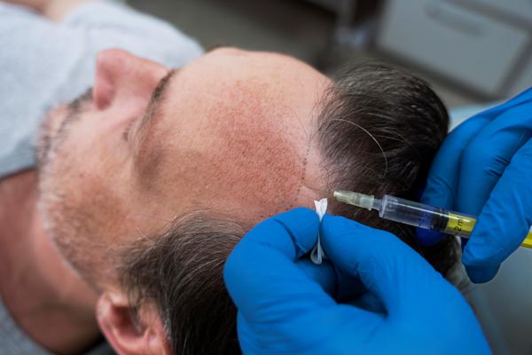 Famosos que se han hecho implantes capilares - Paciente en la consulta del especialista recibiendo un tratamiento capilar mediante una inyección
