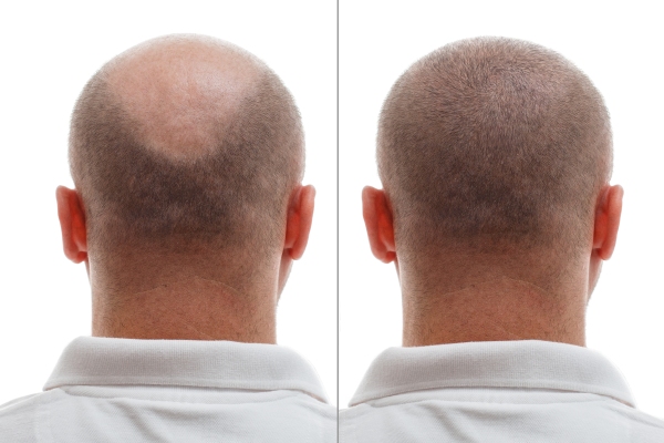 imagen del antes y después del tratamiento en un hombre blanco de espaldas