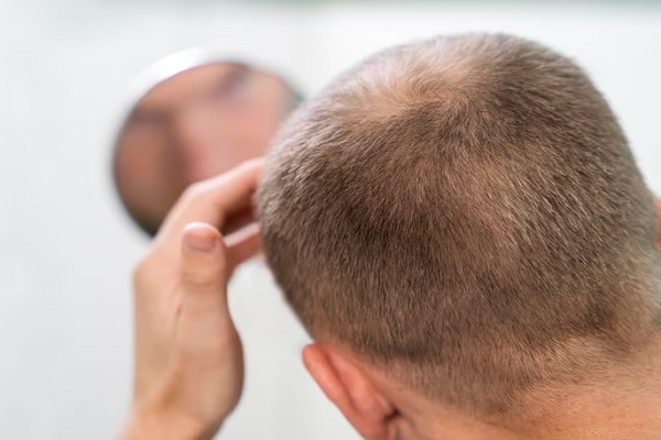 hombre de espaldas en el espejo revisando los resultados del injerto de cabello 