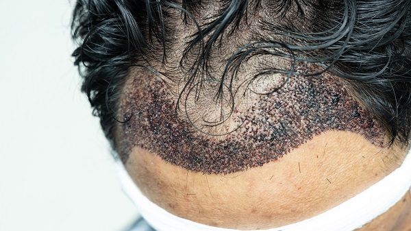 Cómo dormir después de un implante capilar - imagen de la línea del cabello de un hombre que acaba de someterse a una cirugía de implante capilar