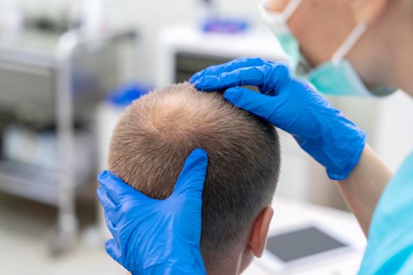implante capilar en Colombia - hombre en la consulta de la tricóloga realizándose una evaluación de sus problemas de alopecia