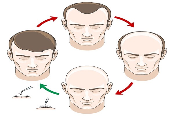 Evolución de implante capilar día a día - Imagen referencial de la evolución de un trasplante capilar, donde el paciente con alopecia puede recuperar su cabello natural
