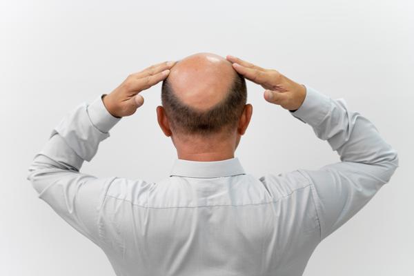 Implante capilar 10 años después - Hombre con alopecia androgénica avanzada, la cual causa la caída del pelo en la parte superior de la cabeza