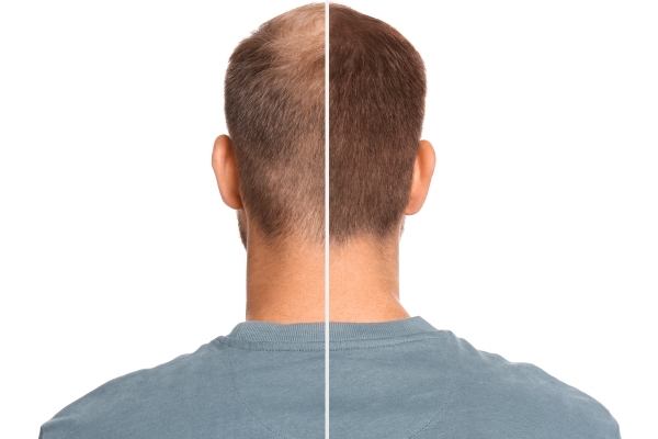 Evolución del injerto de cabello luego de varios meses, el cual permite recuperar la melena y revertir los efectos de la alopecia