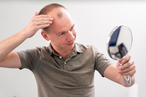 Implante capilar 10 años después - Hombre observando en el espejo el avanza de la alopecia androgénica, la cual causa la caída del cabello en la parte frontal de la cabeza