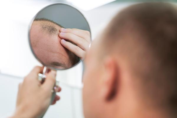 Hombre observando que comienza a salir pelo en la zona afectada por la calvicie, gracias al tratamiento de clonación de cabello