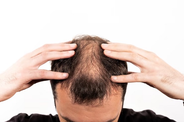 Por qué se nos cae mucho el pelo - Hombre con varios puntos de calvicie en la cabeza, debido al avance de la alopecia areata