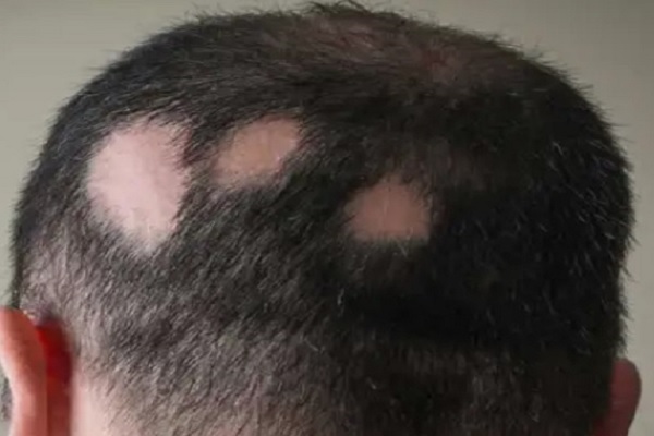 Por qué se nos cae mucho el pelo - Hombre con pérdida de cabello en diferentes partes del cuero cabelludo, debido a la afección llamada tiña