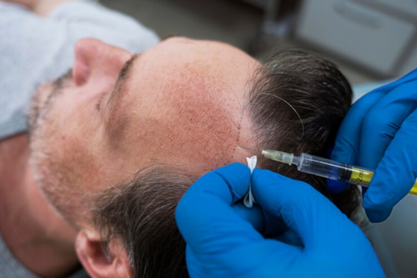 Por qué se nos cae mucho el pelo - Doctor realizando un implante de cabello a un paciente masculino, como tratamiento para la caída del pelo