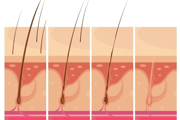 Trasplante capilar 3 meses después - Imagen referencial de la evolución de un trasplante de cabello durante los primeros 3 meses, donde los folículos pilosos comienzan a crecer más fuertes