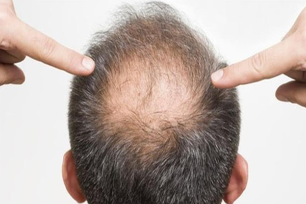 Hombre canoso de espaldas señala la zona occipital de la cabeza con énfasis ante una pérdida de cabello cada vez más acentuada