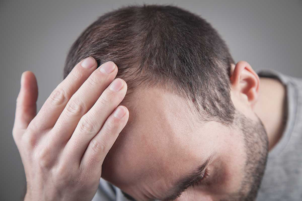 Implante capilar infectado - Beneficiario de trasplante de cabello se percata del desprendimiento irregular de algunas unidades foliculares en la zona frontal de la cabeza