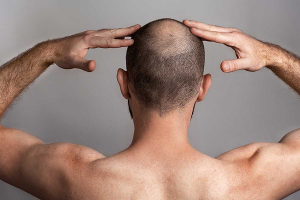 Implante capilar infectado - Caballero con problemas de alopecia coloca sus manos sobre la cabeza para estirar de manera correcta los músculos de los brazos y de la espalda