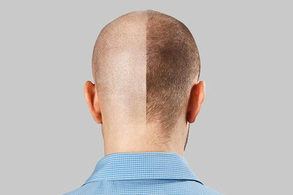 Trasplante capilar 3 meses después - Imagen referencial de la evolución del implante de cabello luego de 3 meses, cuando comienza a crecer el pelo implantado