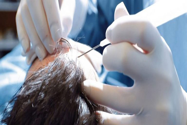 Doctor extrayendo los folículos pilosos de un paciente masculino con la herramienta llamada implanter, la cual permite realizar un trasplante de cabello mediante la técnica DHI