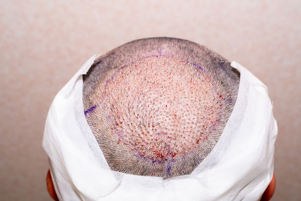 Paciente con vendas en la cabeza inicia proceso de recuperación postoperatorio tras un trasplante de cabello en la zona occipital del cuero cabelludo