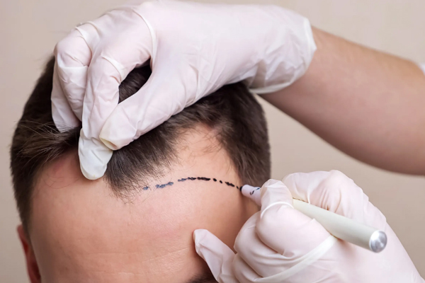 Injerto capilar sin rapar la cabeza - Doctor especialista realizando el boceto del implante de cabello a un hombre, para determinar la cantidad de folículos que se necesitan injertar