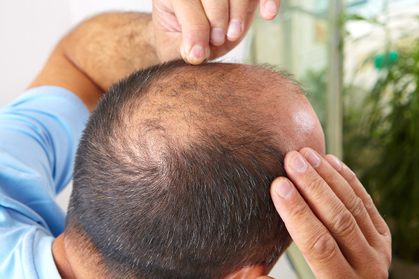 Caballero con alopecia androgénica moderada se mira frente al espejo con preocupación ante el avance de la calvicie en la parte superior de la cabeza