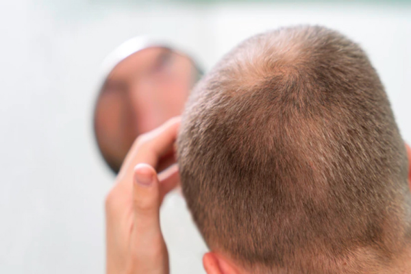 Hombre observando en el espejo el avance postoperatorio del implante de cabello, siguiendo las recomendaciones impartidas por el médico especialista