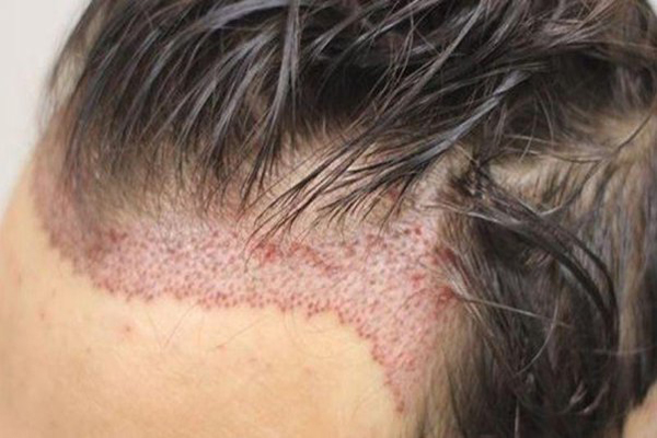 Injerto capilar sin rapar la cabeza - Imagen de un hombre que acaba de recibir el tratamiento de implante capilar utilizando el método FUE, que permite recuperar la cabellera natural sin rapar toda la cabeza