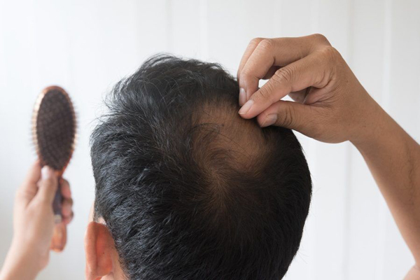 Precio del injerto capilar en la coronilla - Hombre con cepillo en mano palpa la parte posterior de su cabeza ante una persistente pérdida de cabello