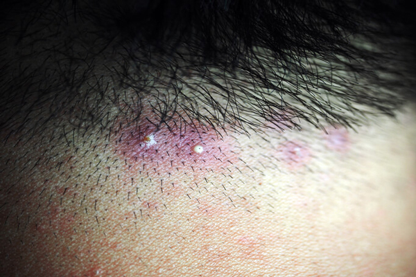 Implante capilar infectado - Vista ampliada de un proceso de foliculitis en la zona frontal de la cabeza