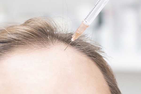 Injerto capilar sin rapar la cabeza - Imagen de un hombre recibiendo un tratamiento de implante de cabello sin rapar, el cual le ayuda a superar la alopecia