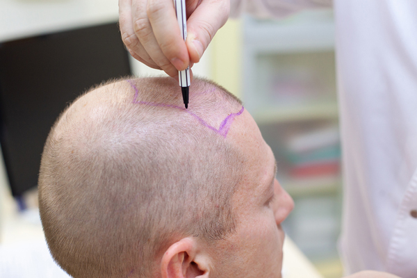 Anestesia en el injerto capilar - Tricólogo realizando el boceto del trasplante de cabello a un hombre con pérdida de cabello en las entradas y coronilla