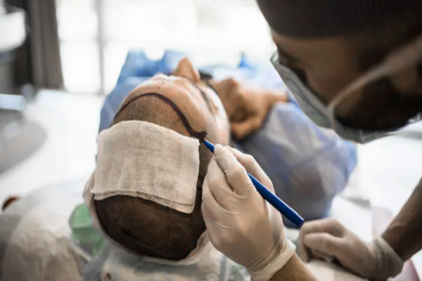 Anestesia en el injerto capilar - Medico especialista realizando el boceto del injerto de cabello a un hombre antes de aplicar la anestesia para el trasplante capilar