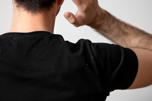 Enfermedades comunes del cuero cabelludo - Hombre de camisa negra se ve expuesto a burlas y a señalamientos públicos por sufrir de caspa 