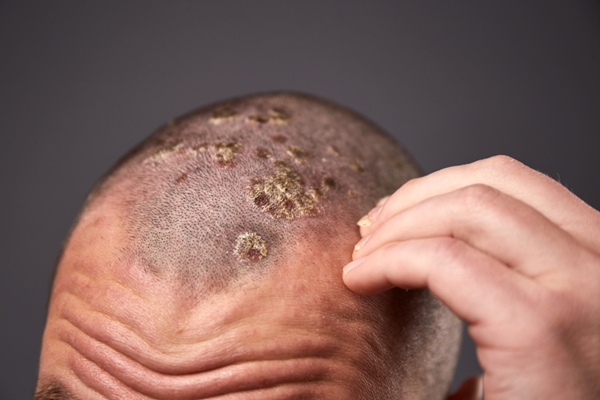 Vista ampliada de un hombre entrando en contacto con lesiones de psoriasis en la superficie cutánea 