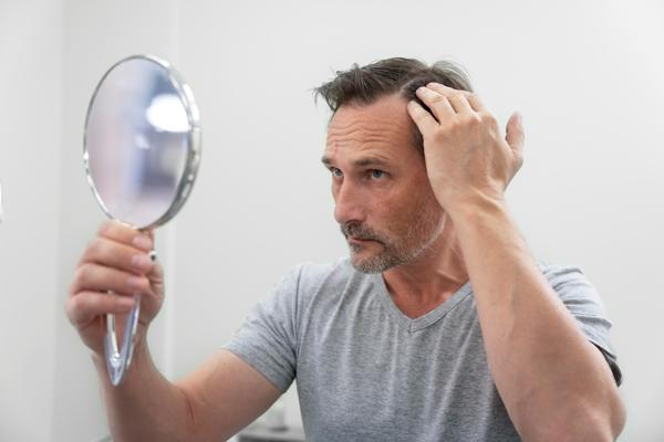 Enfermedades comunes del cuero cabelludo - Hombre con principios de alopecia se mira al espejo con asombro tras el avance de sus entradas en la sien 