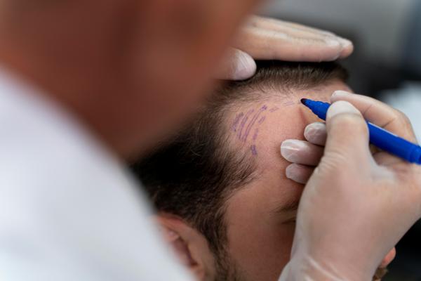 Injerto capilar en las entradas - Cirujano delimita parte de las zonas a cubrir previo a un trasplante de cabello en los laterales de la cabeza de un hombre