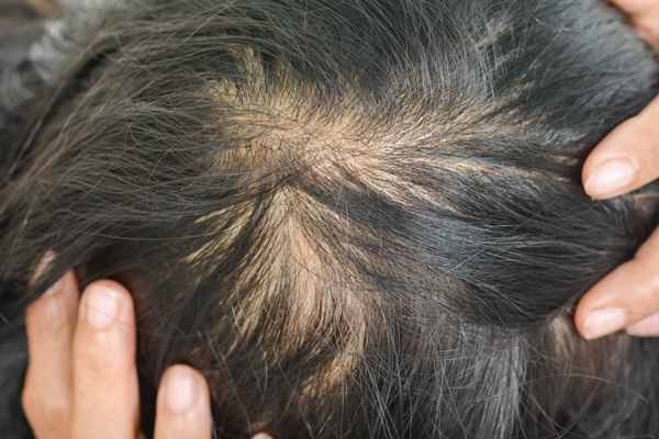 Pica la cabeza - mujer con signos de inflamación del cuero cabelludo de su cabeza