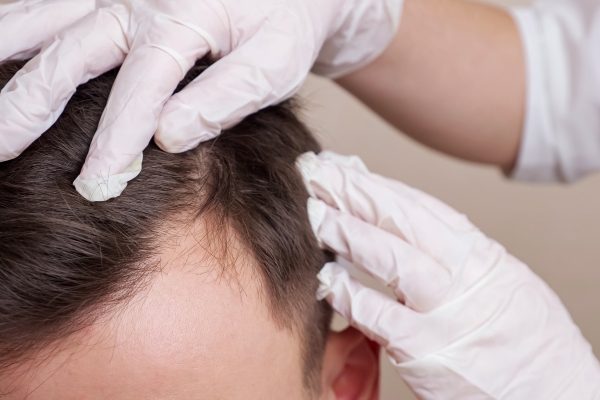 Dermatólogo especializado en tricología examina con detenimiento el cuero cabelludo de un paciente con principios de alopecia