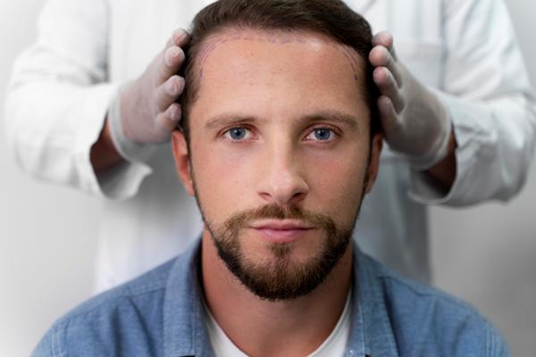 Calvicie y el cabello graso - Médico especialista realizando el boceto del implante de cabello a un paciente, para recuperar la densidad capilar en la zona frontal