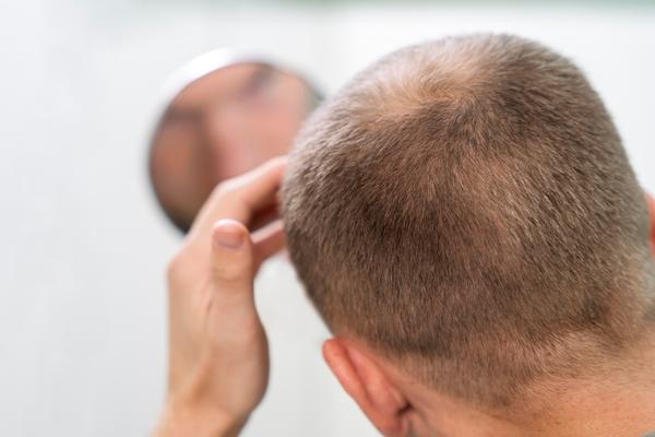 Calvicie y el cabello graso - Hombre observando en el espejo que pierde cabello de manera anormal, generando zonas del cuero cabelludo con calvicie