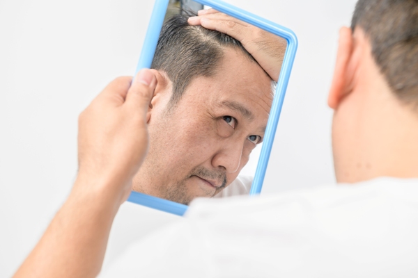 Calvicie y el cabello graso - Hombre observando en el espejo el avance de la alopecia, ocasionando zonas calvas en las entradas del cabello