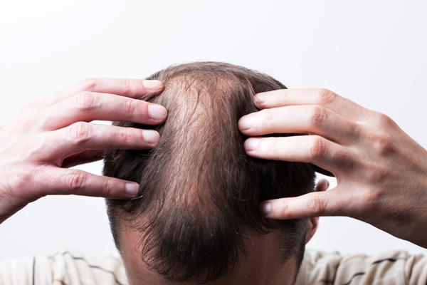 Hombre con alopecia androgénica tocando su cabello, el cual presenta zonas despobladas en las entradas y coronilla