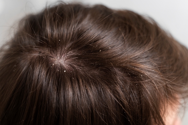 Causas de la caspa - Persona con síntomas de caspa en el cabello, la cual se produce por la descamación del cuero cabelludo debido a un hongo