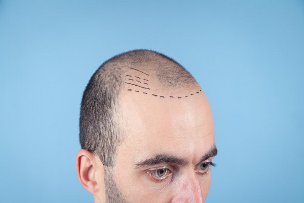 Costras tras el injerto capilar - Hombre con el diseño del injerto capilar en su cabeza, el cual permite repoblar las zonas afectadas por la alopecia
