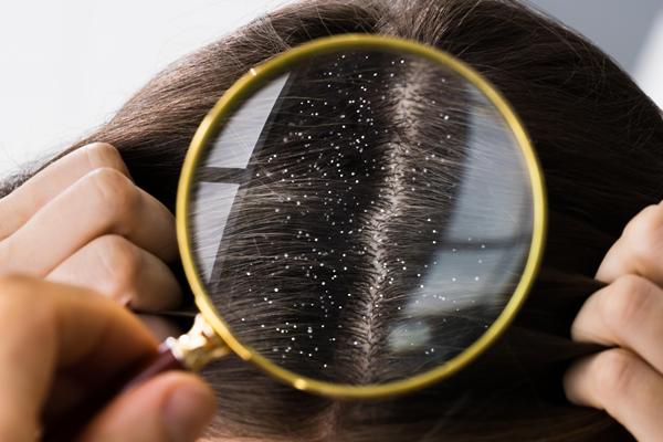 Persona observando a través de la lupa la presencia de escamas blancas en el cabello, las cuales se producen por la descamación del cuero cabelludo