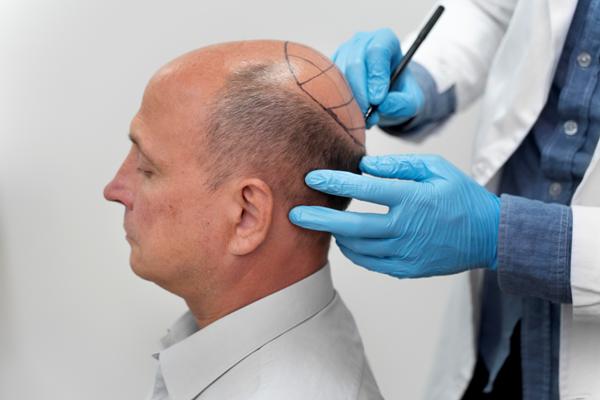 Coronilla despoblada - Médico especialista realizando el boceto del injerto de cabello en un paciente masculino, para revertir los efectos de la alopecia androgénica