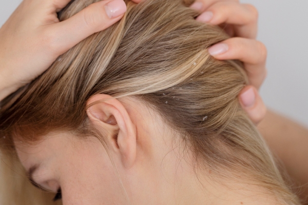 Causas de la caspa - Mujer con síntomas de caspa en su cabello, la cual se genera por el uso excesivo de productos químicos para el pelo