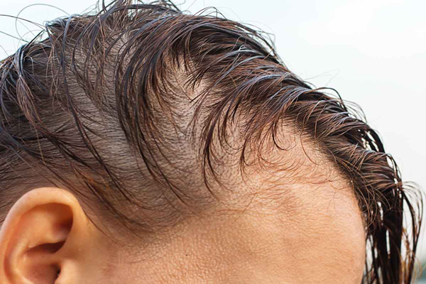 Salud mental - hombre con problemas de perdida de la densidad del cabello en la zona lateral de la cabeza