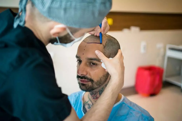 alternativas al trasplante capilar - hombre sentado en la consulta del tricólogo, el cual esta diseñando el implante de cabello