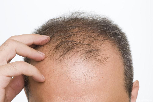 Fumar aumenta la caída del pelo - parte superior de la cabeza de un hombre con problemas graves de alopecia